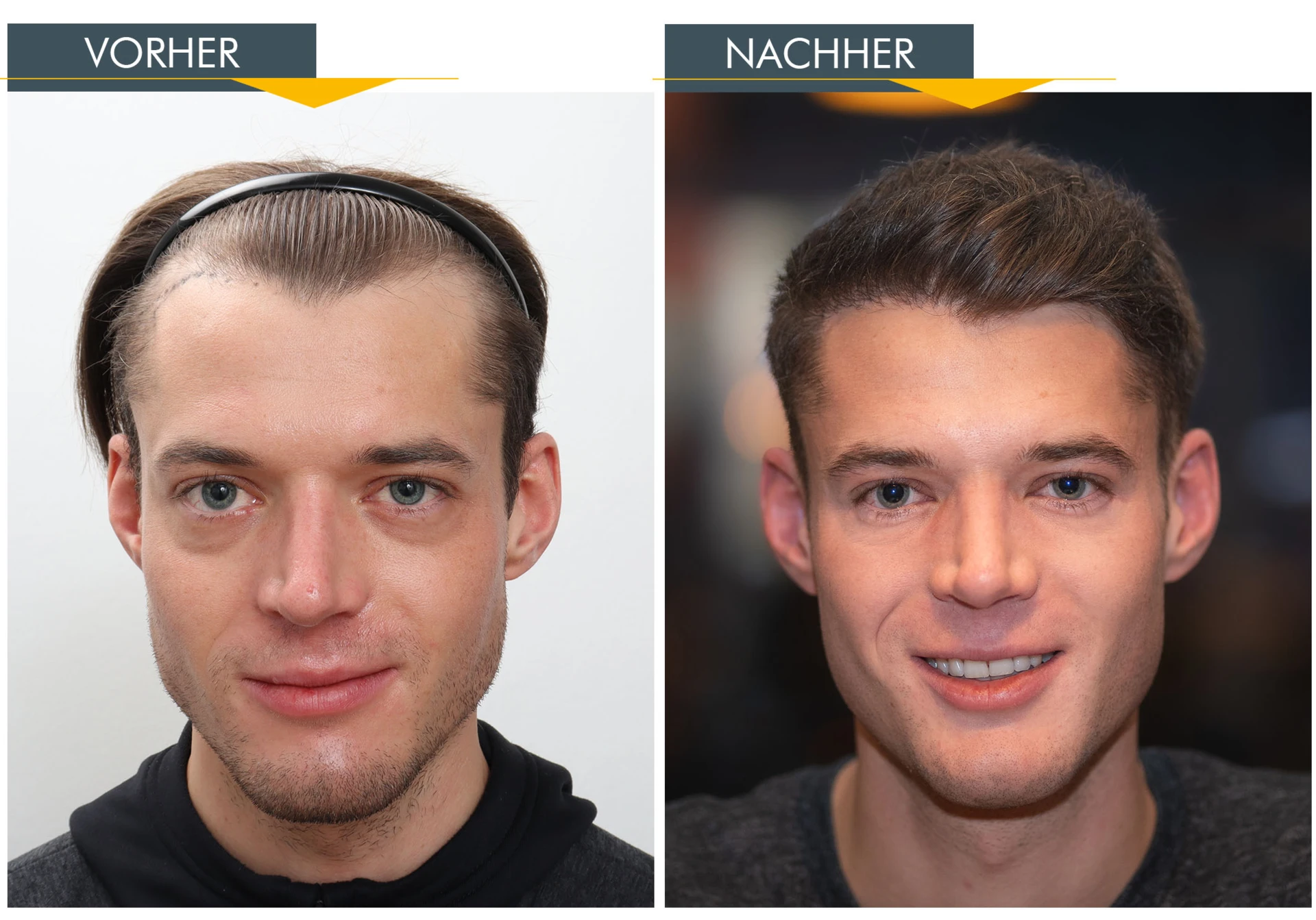 Philipp Aschenwald - Haartransplantation bei Moser Medical