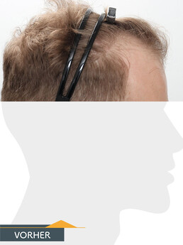 Herr V. S. - Beispiel Stirnhaargrenze vor der Behandlung
