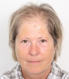 Patientin Sieglinde Felgenhauer zeigt ihren zurückweichenden Haaransatz vor einer Haartransplantation bei Moser Medical