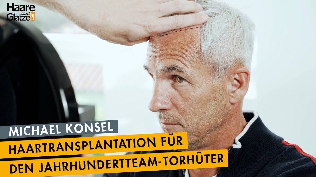 Haartransplantation bei Michael Konsel - So lief seine Behandlung bei Moser Medical ab