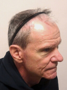 Herr U.J.  vor der Behandlung