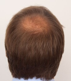 Patient Bernhatd R. zeigt seinen kreisrunden Haarausfall vor der Haartransplantation bei Moser Medical