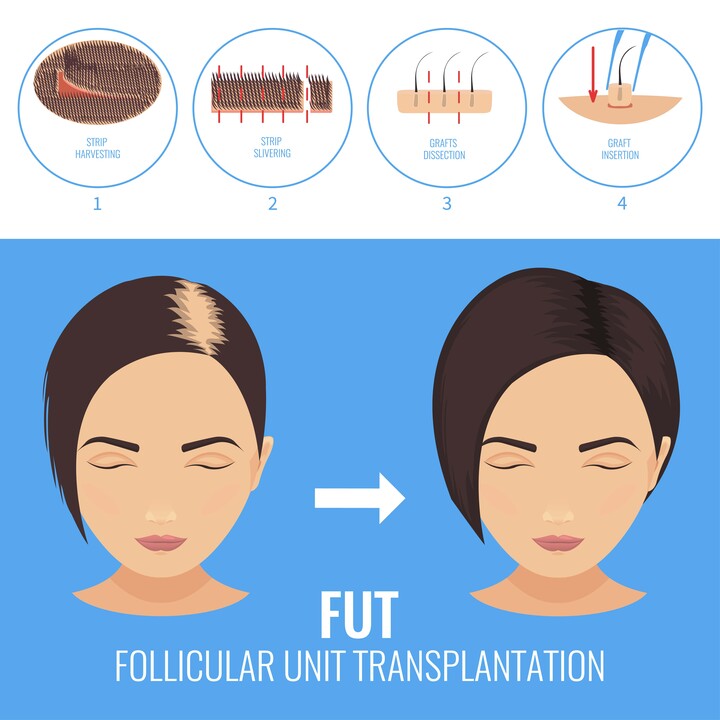 Skizzierung der FUT-Technik von Moser bei einer Frau mit Haarausfall