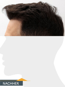 Herr P. O. - Beispiel Stirnhaargrenze nach der Behandlung