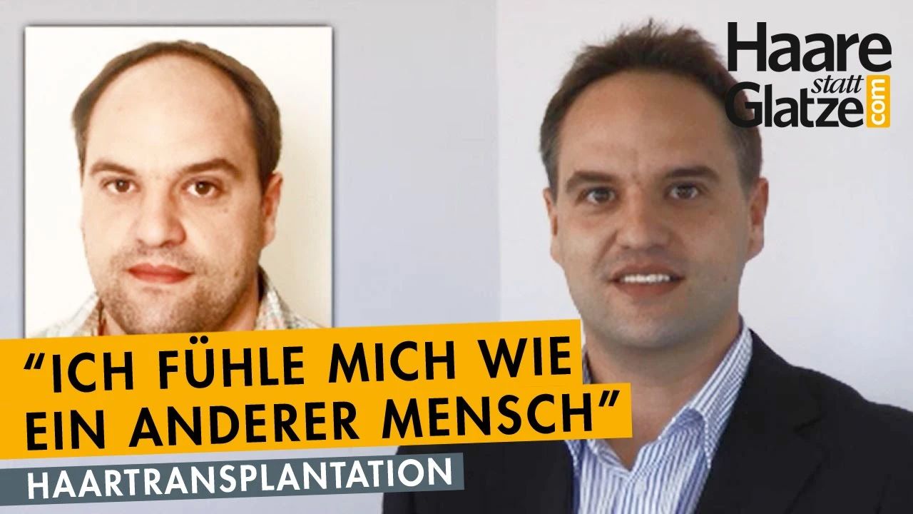 Ing. Werner Zmatlo: Interview 1 Jahr nach der Verpflanzung von Eigenhaar