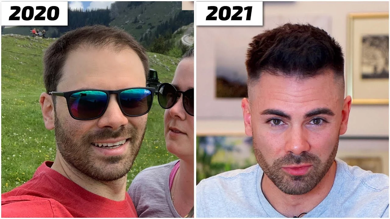 Meine Haartransplantation | Moser Medical - Haare statt Glatze