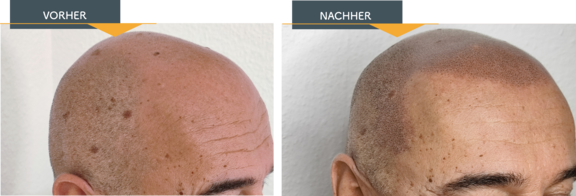 Anwendungsbereiche einer Mikro-Haarpigmentierung