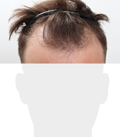Herr V. O. - Beispiel Stirnhaargrenze vor der Behandlung