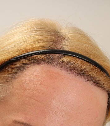 Patientin Angelika H. präsentiert das Ergebnis ihrer Haartransplantation für Frauen mit der Streifenmethode von Moser Medical
