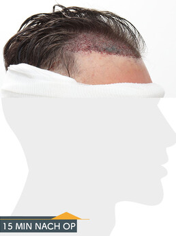 Herr M. D. - Beispiel Stirnhaargrenze vor der Behandlung