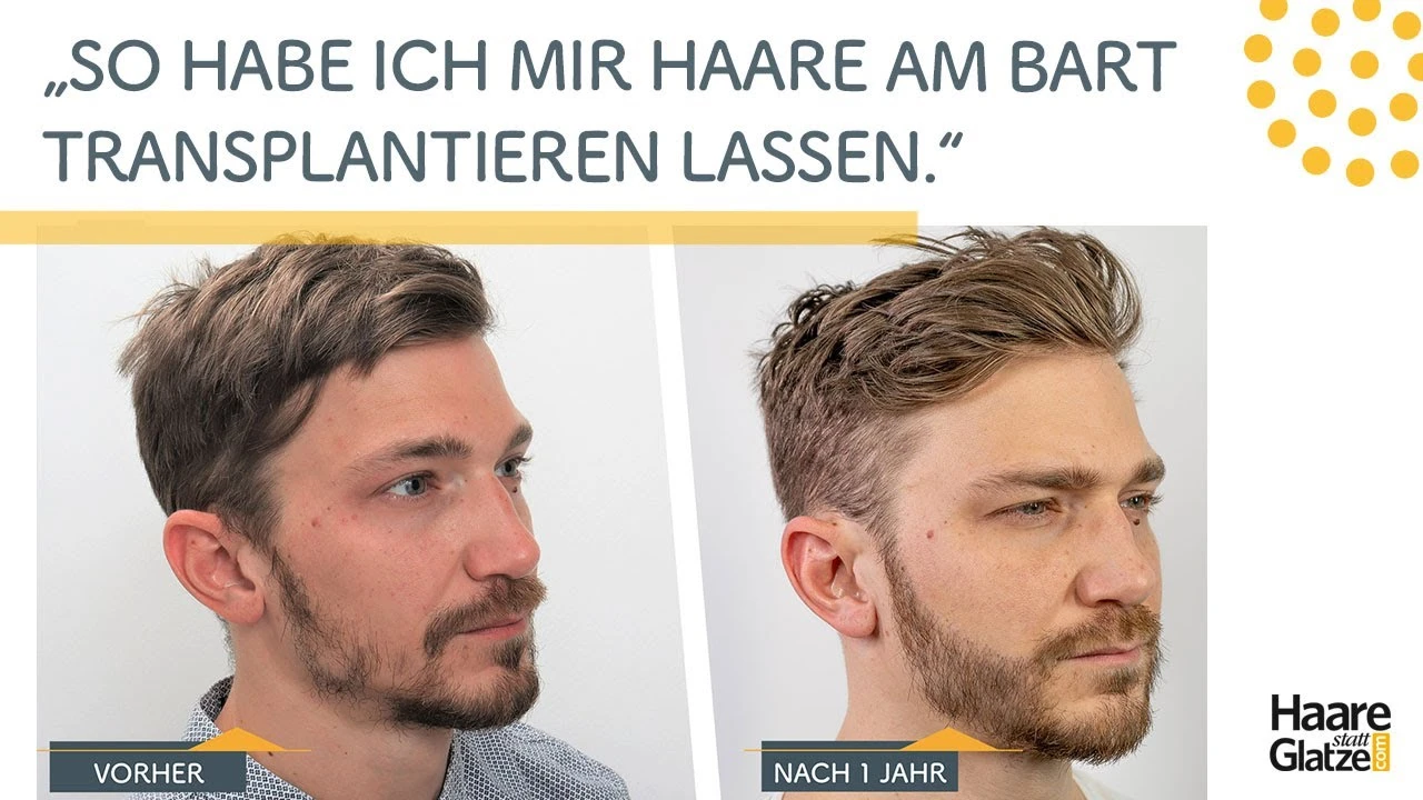 Bart Haartransplantation in Wien - Erfahrungsbericht von Chris, 1 Jahr danach | Moser Medical