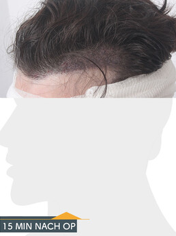 Herr J. P. - Beispiel Stirnhaargrenze vor der Behandlung