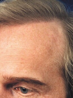Ergebnis der Haartransplantation 1998