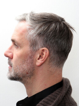 Stefan Maierhofer vor der Behandlung