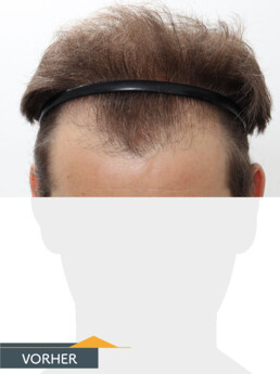 Herr K. W. - Beispiel Stirnhaargrenze vor der Behandlung