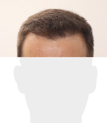 Herr K. W. - Beispiel Stirnhaargrenze nach der Behandlung
