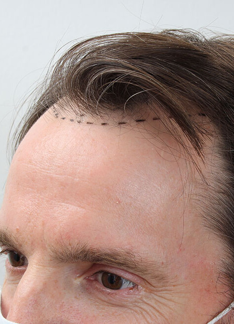 Vor der Haartransplantation