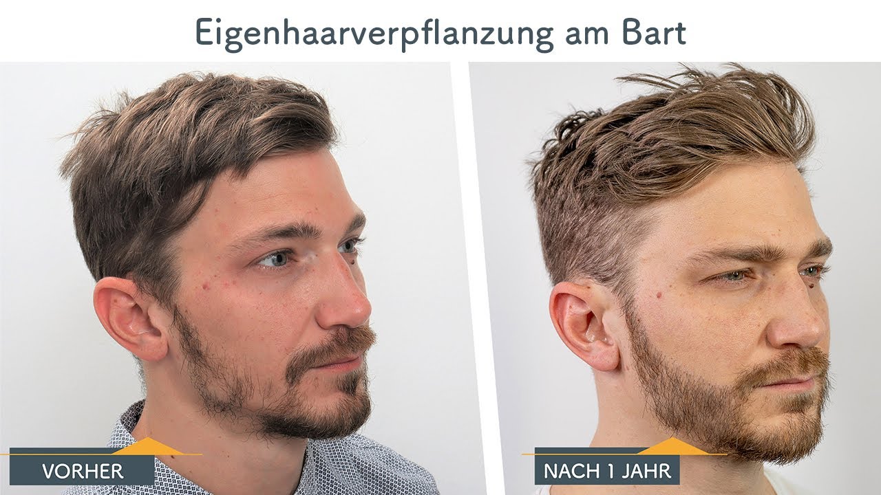 Bart Haartransplantation in Wien - Erfahrungsbericht von Chris, 1 Jahr danach | Moser Medical