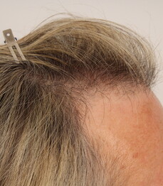 Patientin Angelika H. vor der Haartransplantation für Frauen mit der Streifenmethode von Moser Medical