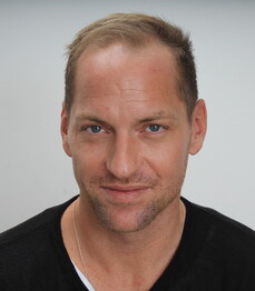 Beachvolleyballer Alexander Horst vor der Haartransplantation bei Moser Medical