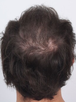 5 Monate nach der Haartransplantation