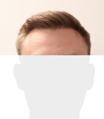 Herr S. Z. - Beispiel Geheimratscekcen nach der Behandlung