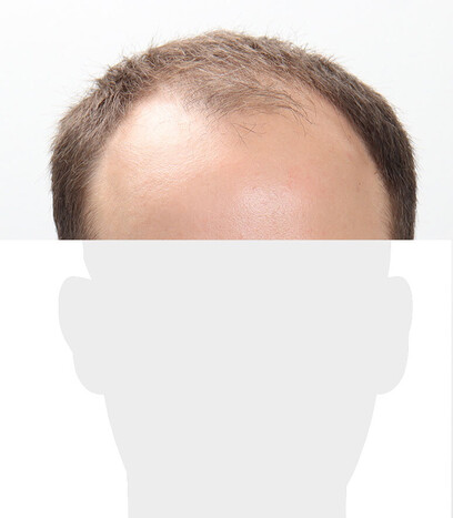 Herr C. P. - Beispiel Stirnhaargrenze vor der Behandlung