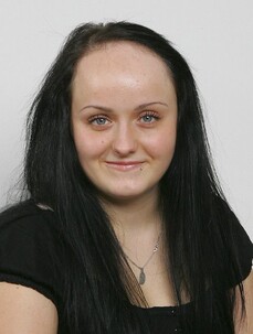 Patientin Stefanie Grill zeigt ihre hohe Stirn vor einer Haartransplantation bei Moser Medical