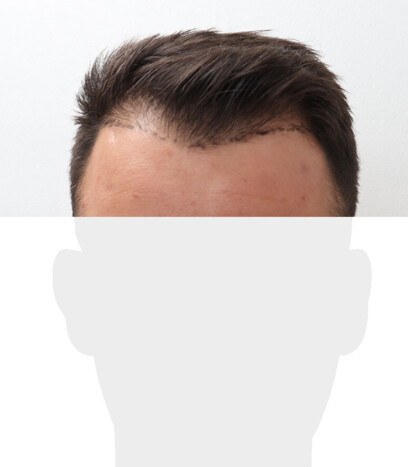 Herr P. O. - Beispiel Geheimratsecken vor der Behandlung