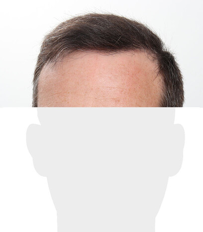 Herr W. K. - Beispiel Stirnhaargrenze nach der Behandlung