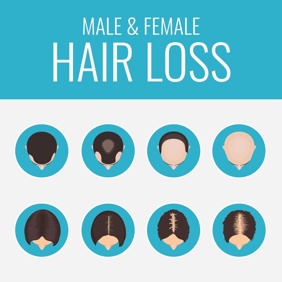 Die verschiedenen Arten von Haarausfall bei Frauen und Männern