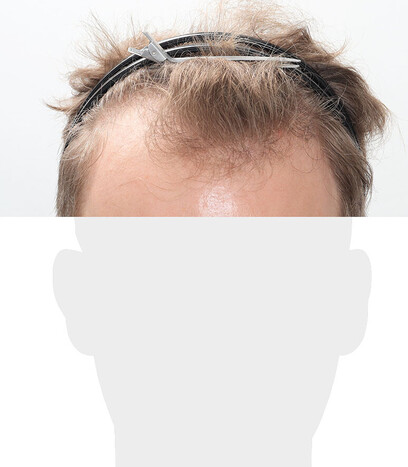 Herr V. S. - Beispiel Stirnhaargrenze vor der Behandlung