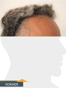 Herr F. S. - Beispiel Stirnhaargrenze vor der Behandlung