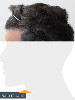 Herr J. P. - Beispiel Stirnhaargrenze nach der Behandlung