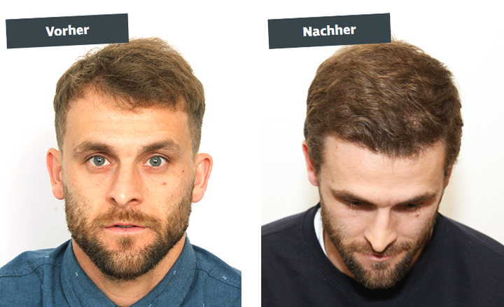 Philipp Huspek vor und nach seiner Haartransplantation bei Moser Medical