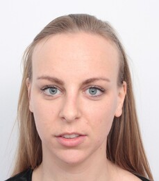 Patientin Sabrina T. zeigt ihre hohe Stirn vor einer Haartransplantation bei Moser Medical
