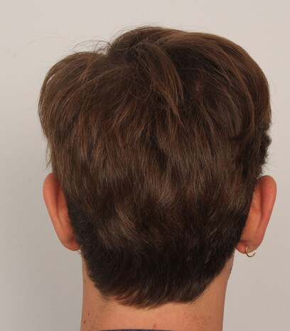 Der Entnahmebereich von Patient Herr H.P. vor seiner Haartransplantation bei Moser Medical