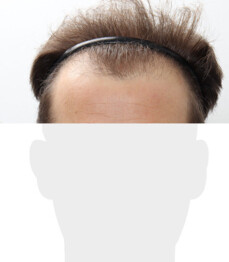 Herr K. W. - Beispiel Stirnhaargrenze vor der Behandlung