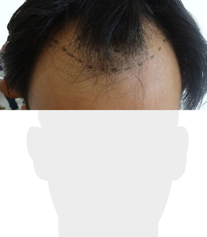 Herr F. M. - Beispiel Stirnhaargrenze vor der Behandlung