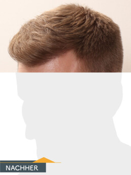 Herr S. Z. - Beispiel Stirnhaargrenze nach der Behandlung
