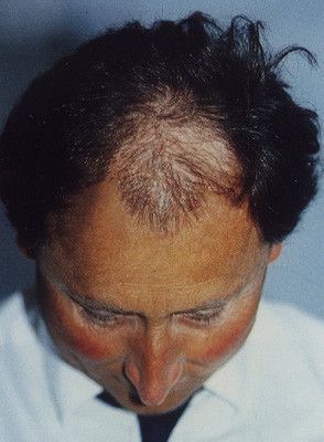 Patient Alfons Wieland vor der Haartransplantation bei Moser Medical vor 20 Jahren