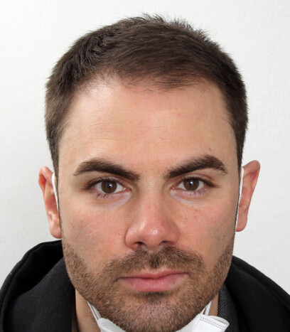 Michael vor seiner Haartransplantation.