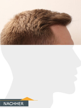 Herr S. Z. - Beispiel Stirnhaargrenze nach der Behandlung