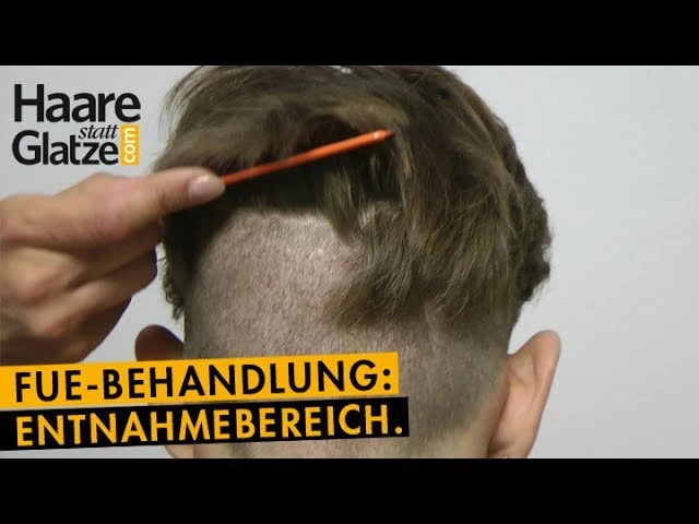 FUE-Haartransplantation: So sieht der Spenderbereich nach 6 Tagen aus