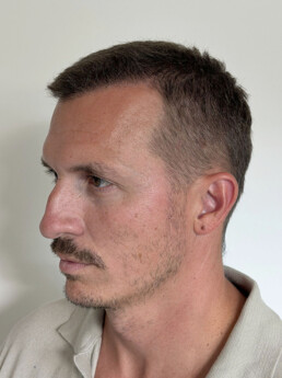 Rene Pranz nach der Behandlung