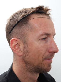 Marc Janko vor der Behandlung