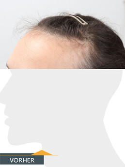 Frau J. Q. - Beispiel Stirnhaargrenze vor der Behandlung