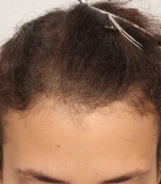 Patientin zeigt ihre Geheimratsecken vor der Haartransplantation bei Moser Medical