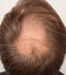 Patient Herr S. vor einer Haartransplantation bei Moser Medical