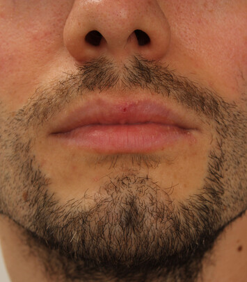Patient Herr A.L. präsentiert das Ergebnis seiner Bartverpflanzung bei Moser Medical